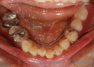 金属バネを使った従来型部分義歯 1