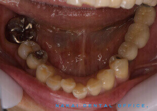 インプラントによる固定式義歯 1