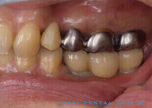 インプラントによる固定式義歯 2