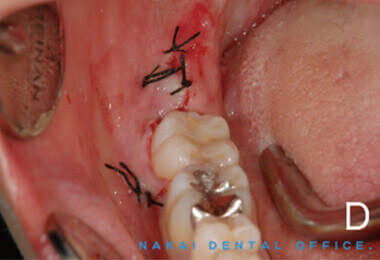 埋伏歯の抜歯の様子 3