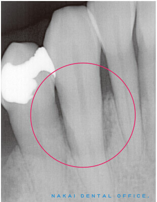 歯周外科処置　B　再生療法（健康保険適用外）1 術前