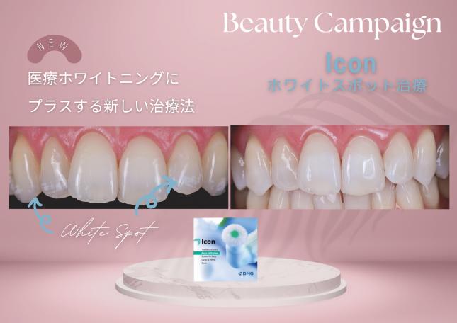 マウスピース矯正・ホワイトスポットが気になる方に