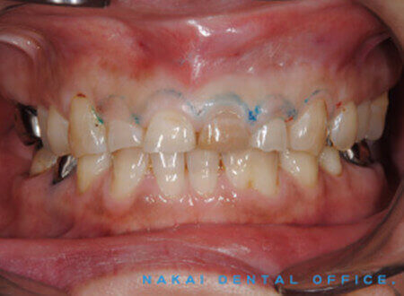 歯茎整形+歯冠セラミック修復+ホワイトニング 歯茎の整形を行い、歯冠修復を一部セラミックで行い 他はホワイトニング