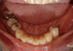 歯が部分的にないケース下顎大臼歯の複数連続欠損に対する種々の補綴法 術前