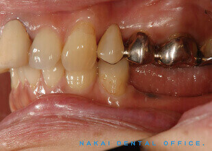 歯が部分的にないケース下顎大臼歯の複数連続欠損に対する種々の補綴法 術後