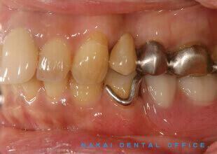 金属バネを使った従来型部分義歯 2