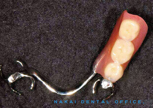 金属バネを使った従来型部分義歯 3