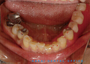 金属を使わない特殊部分義歯（ノンメタルクラスプデンチャー） 1