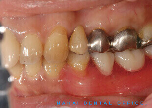 金属を使わない特殊部分義歯（ノンメタルクラスプデンチャー） 2