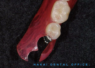 金属を使わない特殊部分義歯（ノンメタルクラスプデンチャー） 3