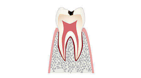 C1 歯の表面の虫歯