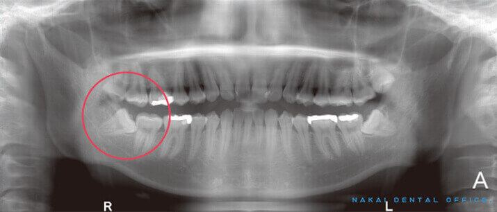 水平埋伏知歯のパノラマ画像