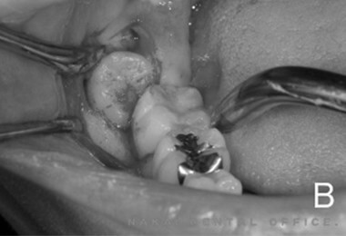 埋伏歯の抜歯の様子 1