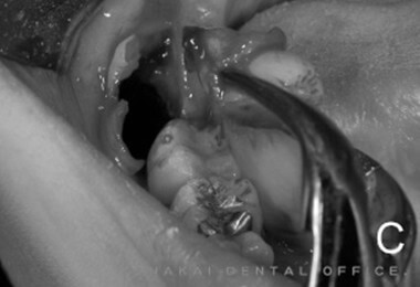 埋伏歯の抜歯の様子 2