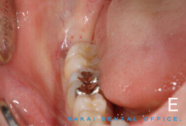埋伏歯の抜歯の様子 4