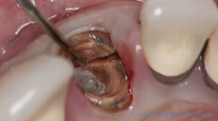 外傷による歯牙脱臼(しがだっきゅう)<br>歯根破切(しこんはせつ)処置