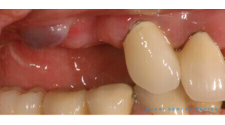歯根膿胞や良性腫瘍の外科的除去