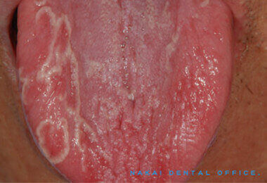 口腔粘膜疾患の例 1