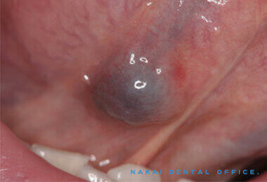 口腔粘膜疾患の例 2