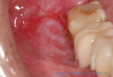 口腔粘膜疾患の例 3