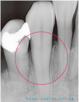 歯周外科処置　B　再生療法（健康保険適用外）1 術後