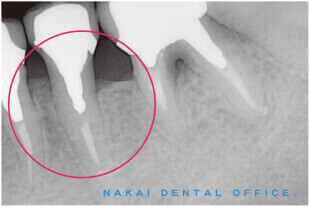 歯周外科処置　B　再生療法（健康保険適用外）1 術後