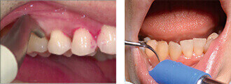 (1）バイオフィルム・歯石などの除去 1