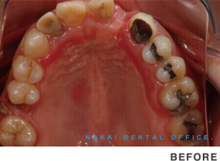 虫歯や歯周病の予防と管理 BEFORE