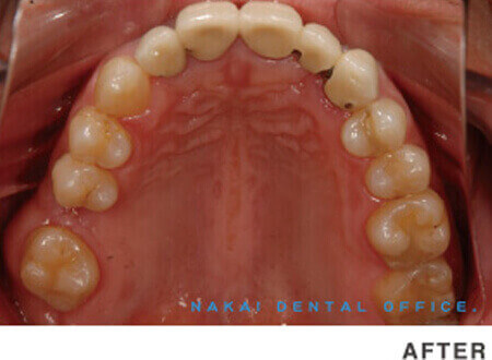虫歯や歯周病の予防と管理 AFTER