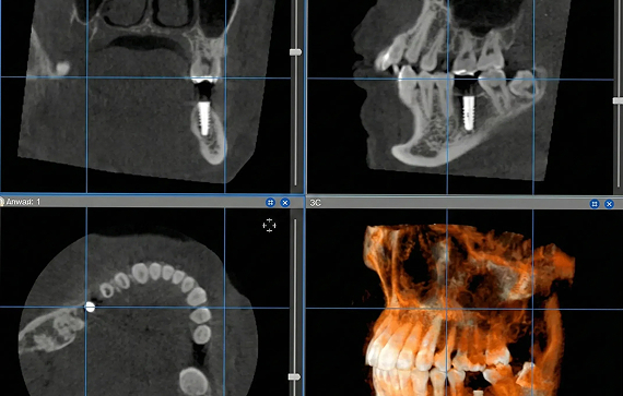 CT・3Dシミュレーションによる正確な診断
