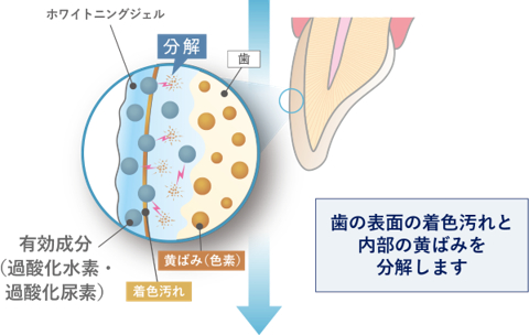 医療ホワイトニングの様子 2